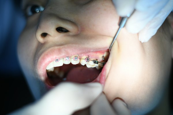 Broches linguales et invisibles : les alternatives discrètes en orthodontie